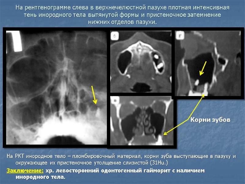 На рентгенограмме слева в верхнечелюстной пазухе плотная интенсивная тень инородного тела вытянутой формы и